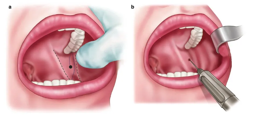 تکنیک بلوک عصبی