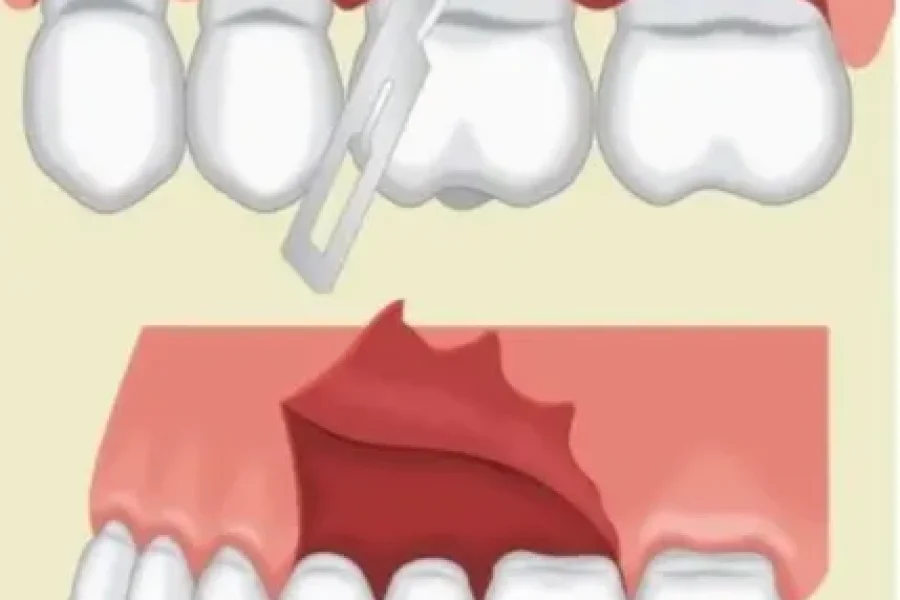 فلپ پاکتی مناسب‌تر است یا فلپ مثلی؟